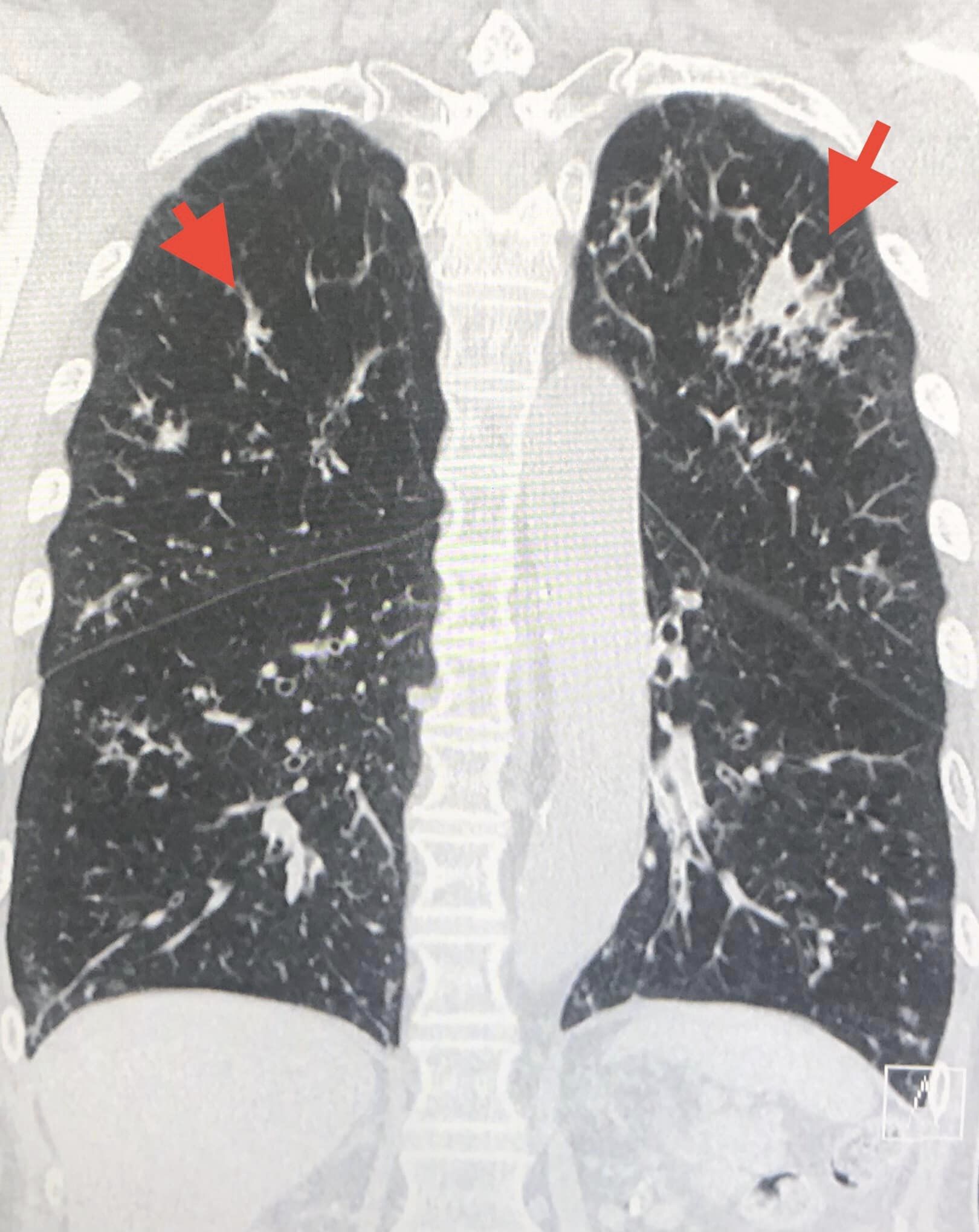 หมอมนูญเผยเคสผู้ป่วย “ปอดติดเชื้อจากราในเมล็ดข้าวโพด” หมอมนูญเผยเคสผู้ป่วย “ปอดติดเชื้อจากราในเมล็ดข้าวโพด”