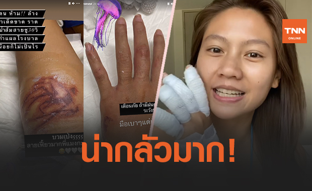 'เมทัล' โดนแมงกะพรุนไฟเล่นงาน จนเป็นแผลไหม้ทั้งแขน-ขา