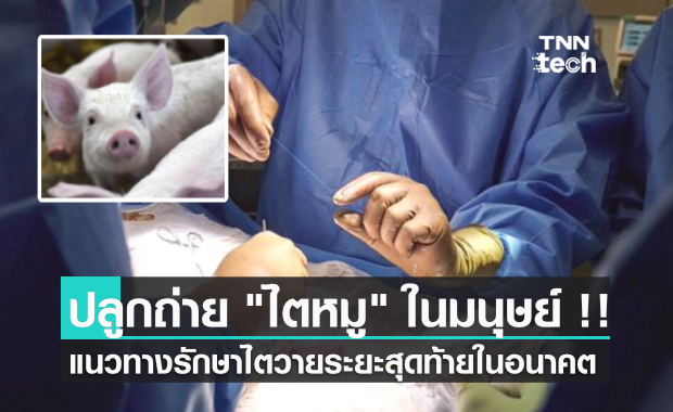 ทีมแพทย์นิวยอร์กปลูกถ่าย "ไตหมู" ในมนุษย์ได้สำเร็จเป็นครั้งแรกของโลก !!