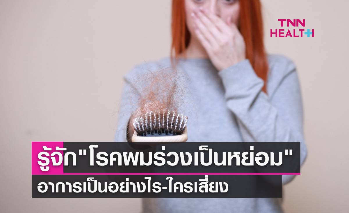 "โรคผมร่วงเป็นหย่อม" อาการไม่อันตราย แต่มีผลกับจิตใจผู้ป่วย