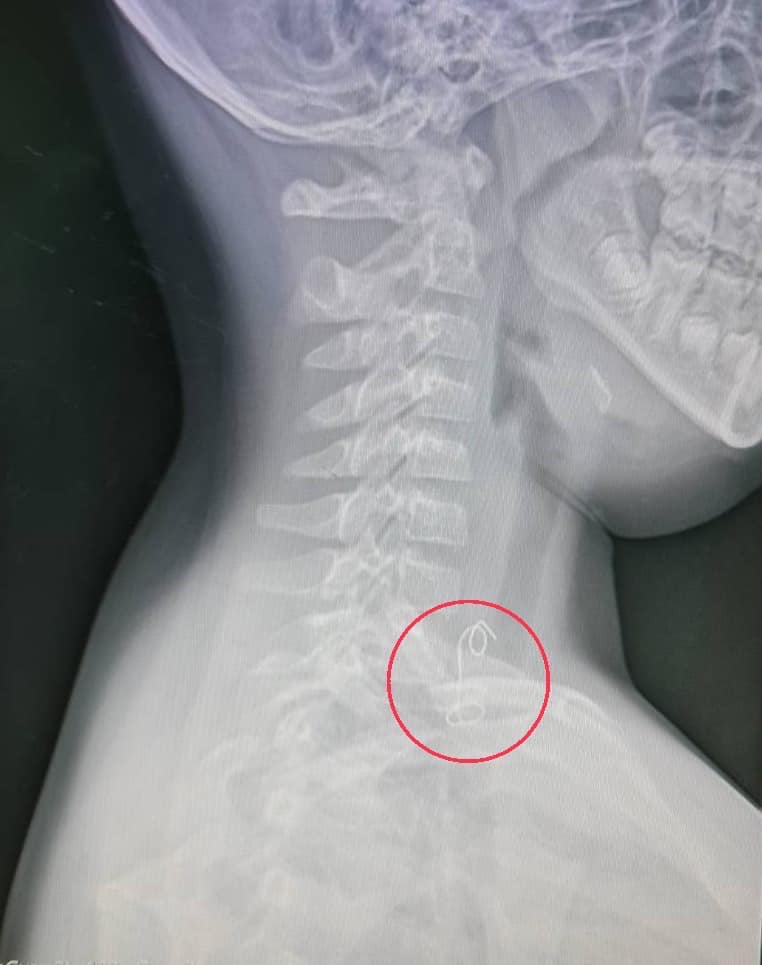 เคสอุทาหรณ์! เด็กกินไก่ย่างไม่ระวัง ลวดมัดติดหลอดอาหาร ต้องผ่าตัดด่วน เคสอุทาหรณ์! เด็กกินไก่ย่างไม่ระวัง ลวดมัดติดหลอดอาหาร ต้องผ่าตัดด่วน