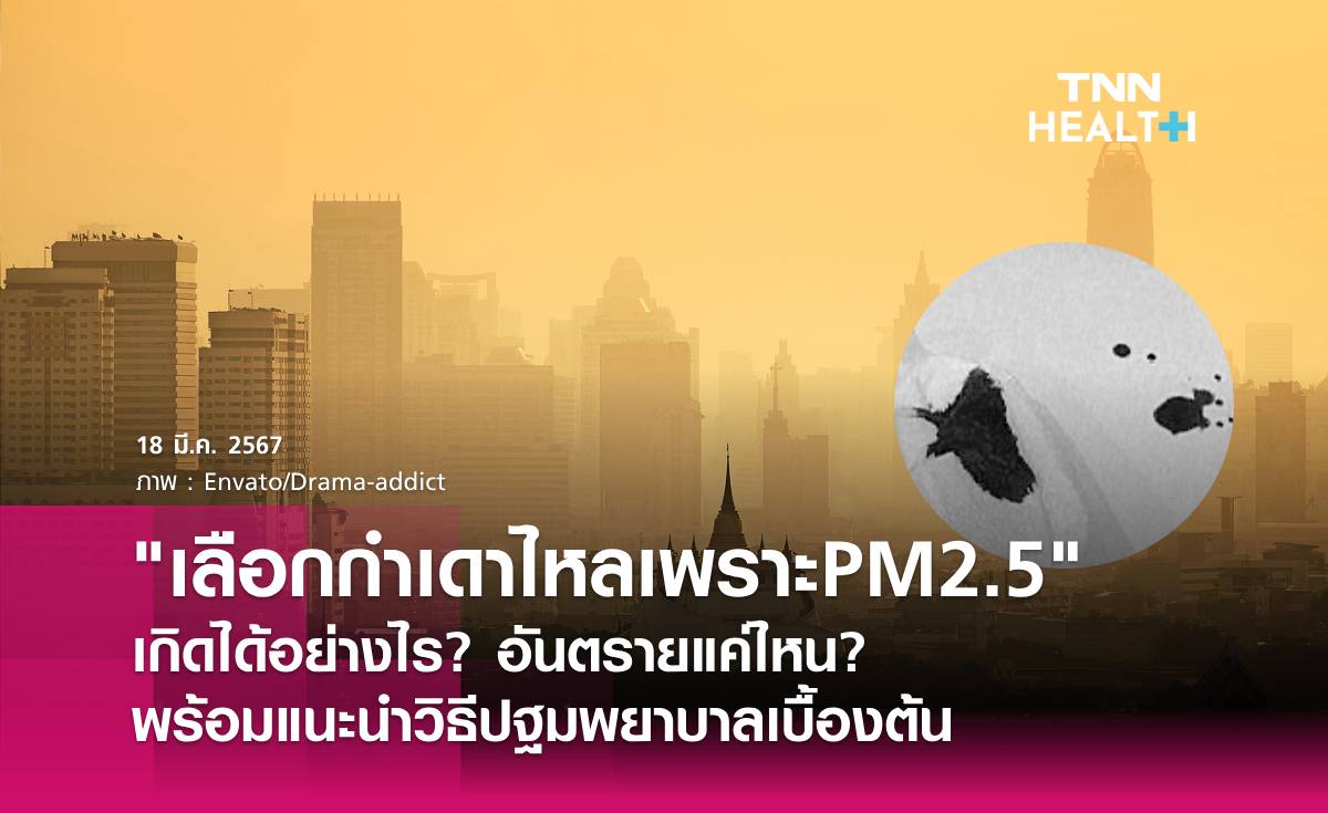 เลือดกำเดาไหลเพราะPM2.5 เกิดได้อย่างไร? อันตรายแค่ไหน? 