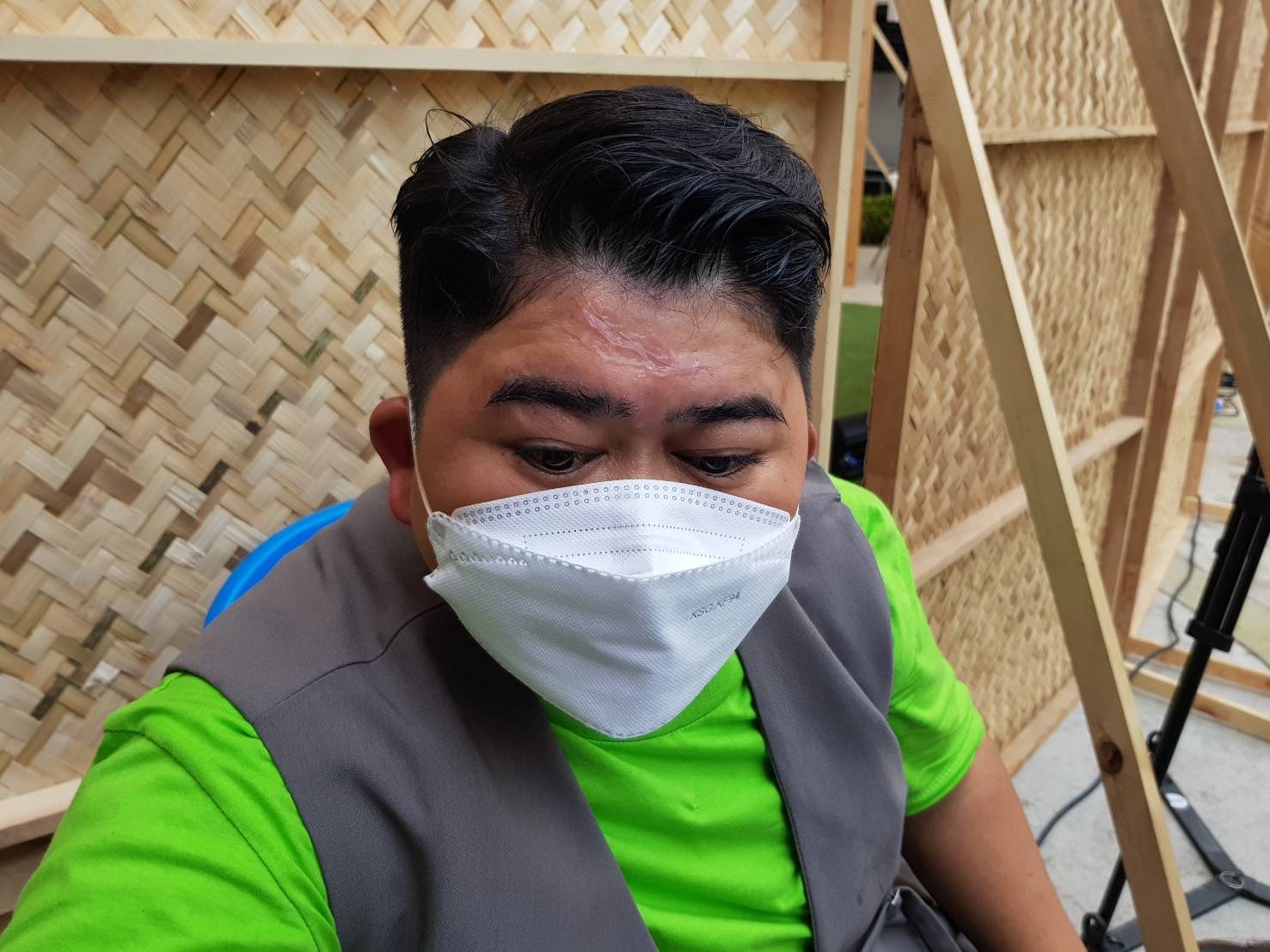 โก๊ะตี๋ เกิดอุบัติเหตุ หน้าผากพุพอง จากโดนฝาซึ้งร้อน ๆขณะถ่ายรายการ