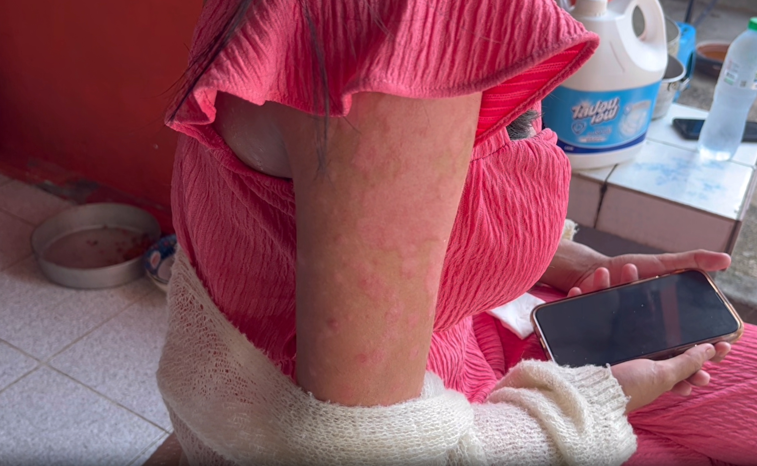 ความเสี่ยงที่ทำให้เกิด โรคพุ่มพวง หรือ โรคแพ้ภูมิตัวเอง 