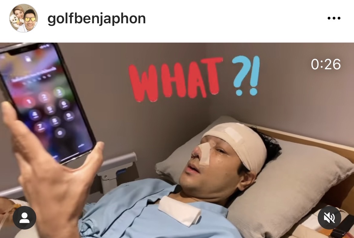 กอล์ฟ เบญจพล อัปเดตหลังเสริมหล่อ ถูกโทรศัพท์แกงหนัก จำหน้าไม่ได้?!  