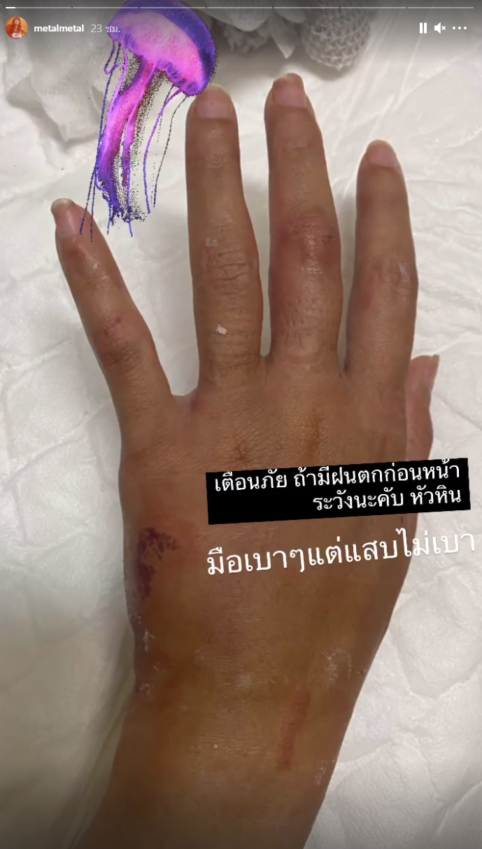 'เมทัล' โดนแมงกะพรุนไฟเล่นงาน จนเป็นแผลไหม้ทั้งแขน-ขา 'เมทัล' โดนแมงกะพรุนไฟเล่นงาน จนเป็นแผลไหม้ทั้งแขน-ขา