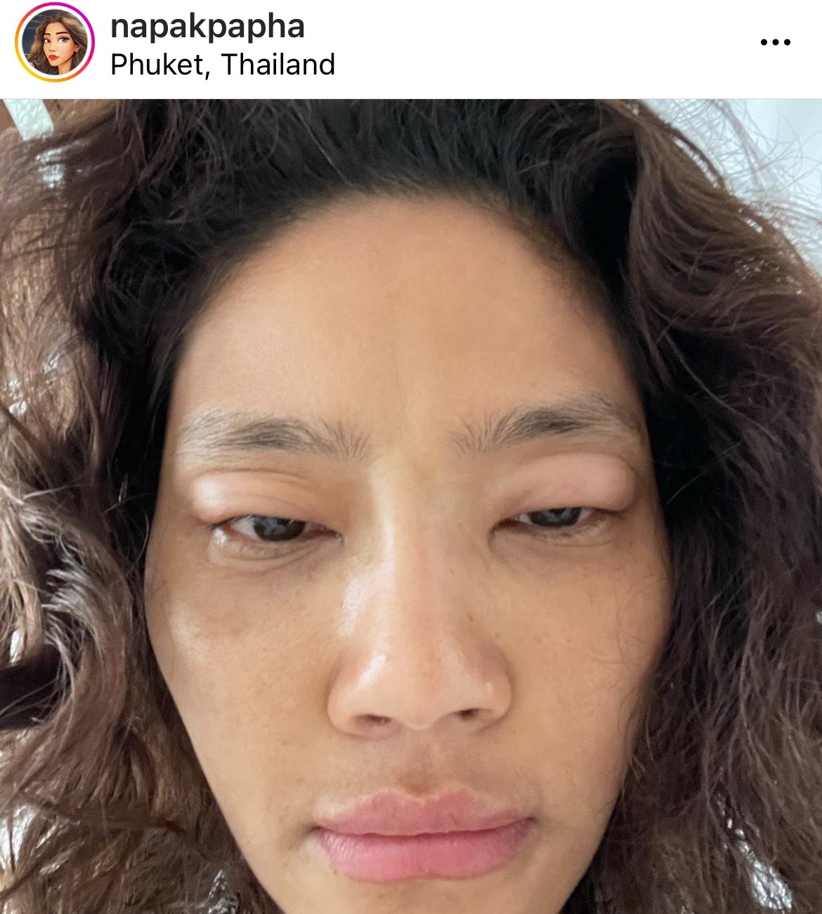 มะหมี่ นภคปภา เกิดอาการแพ้น้ำยาซักผ้ารุนแรง ถึงขั้นหายใจไม่ออก ตาบวม 