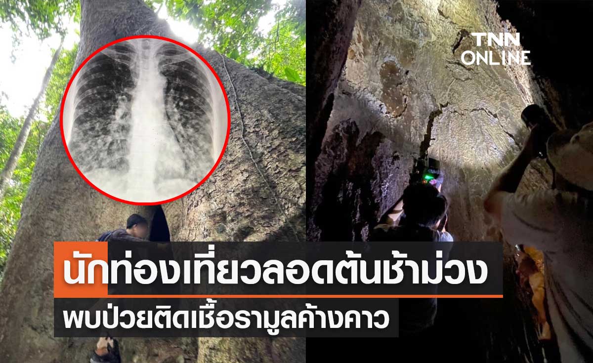 หมอมนูญ เตือน นักท่องเที่ยวลอดโพรงต้นช้าม่วง พบป่วยติดเชื้อราจากมูลค้างคาว