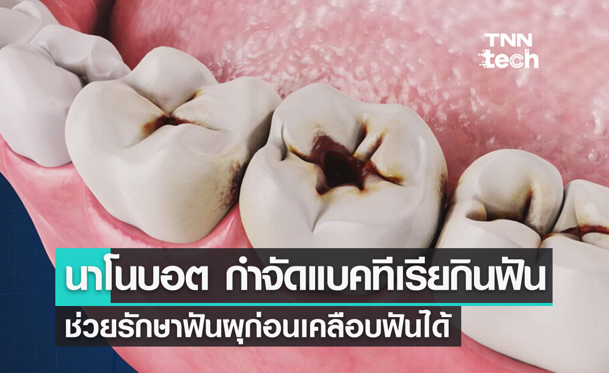 อินเดียพัฒนา "นาโนบอต" หุ่นยนต์จิ๋วกำจัดแบคทีเรียในฟันผุด้วยความร้อน