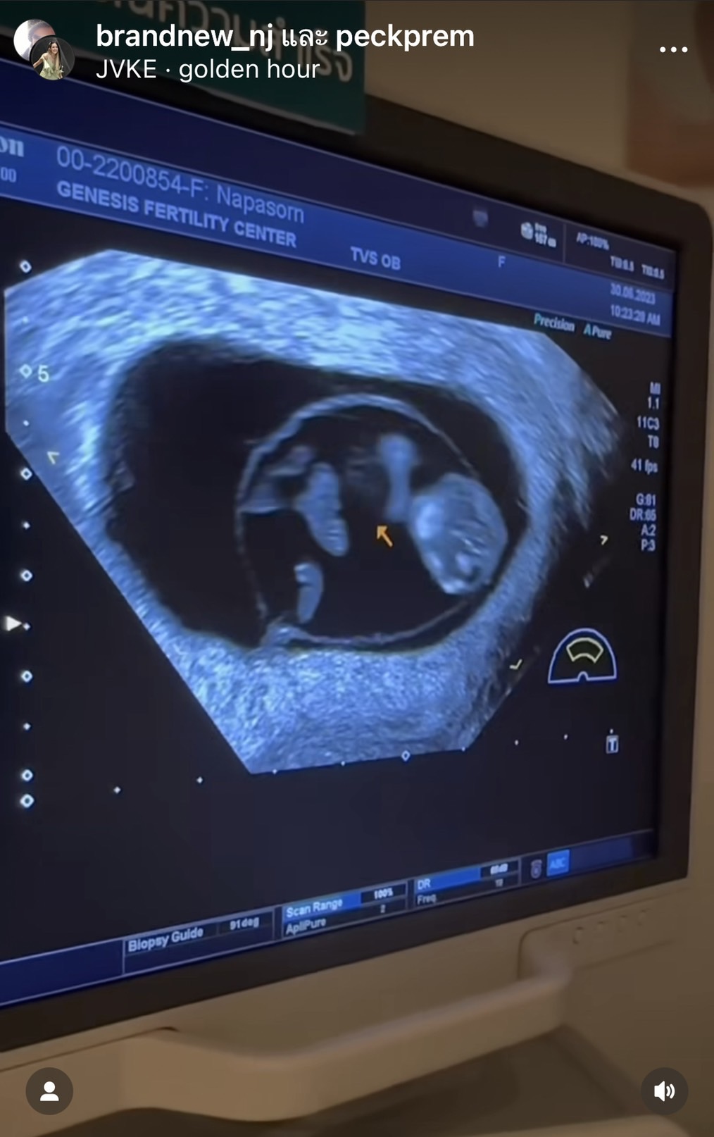 เป๊ก - นิว จุดพลุฉลอง ทายาทคนแรกมาแล้ว เตรียมพร้อมเดินสายแก้บน 