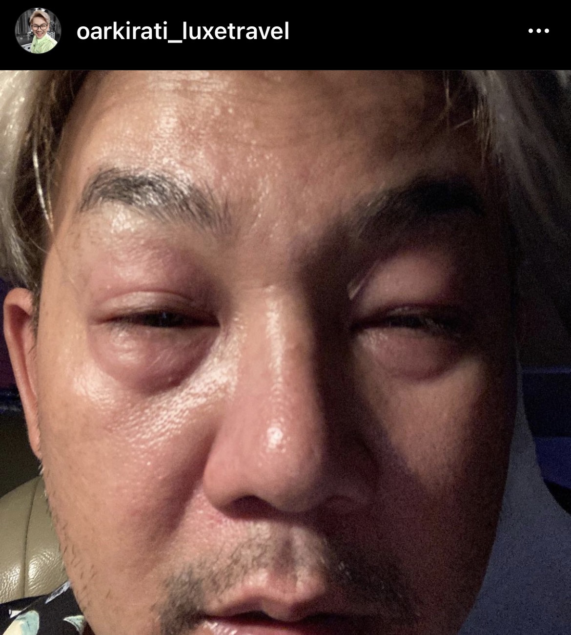 “เอ๊าะ” เปิดใจ ได้กลับบ้านแล้ว หลังแอ็ดมิทเพราะแพ้ส่วนประกอบในอาหาร “เอ๊าะ” เปิดใจ ได้กลับบ้านแล้ว หลังแอ็ดมิทเพราะแพ้ส่วนประกอบในอาหาร