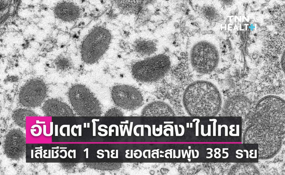 อัปเดตโรคฝีดาษลิง! เสียชีวิต 1 ราย ยอดติดเชื้อสะสมในไทยพุ่ง 385 ราย 