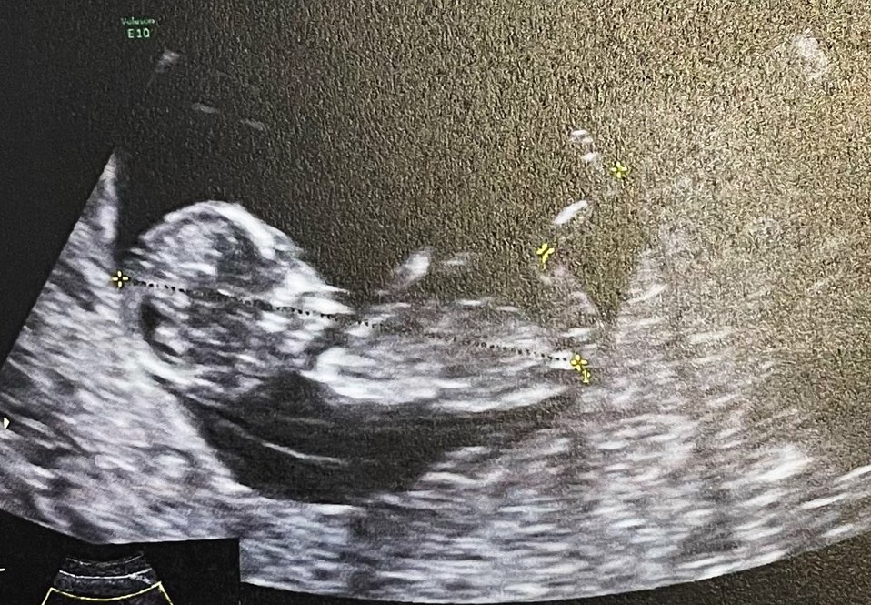 ท้องแล้ว!! น้ำชา ชีรณัฐ อวดภาพอัลตราซาวน์ พร้อมเป็นคุณแม่เต็มตัว ท้องแล้ว!! น้ำชา ชีรณัฐ อวดภาพอัลตราซาวน์ พร้อมเป็นคุณแม่เต็มตัว